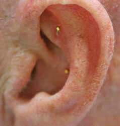 Acupuncture: Ancient methods used by modern-day providers