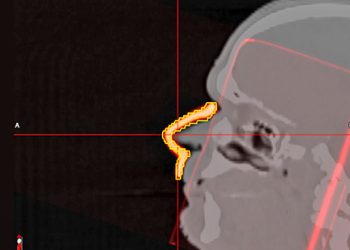 VA’s 3D printed boluses revolutionizing radiation therapy for Veterans