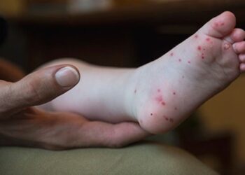 Hand, foot and mouth disease: What parents need to know
